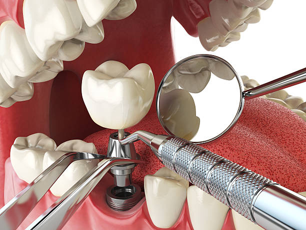 Best Emergency Root Canal Treatment in Niles, OH